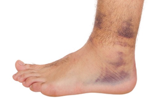 Ankle Sprains Can Be More Than a Minor Injury